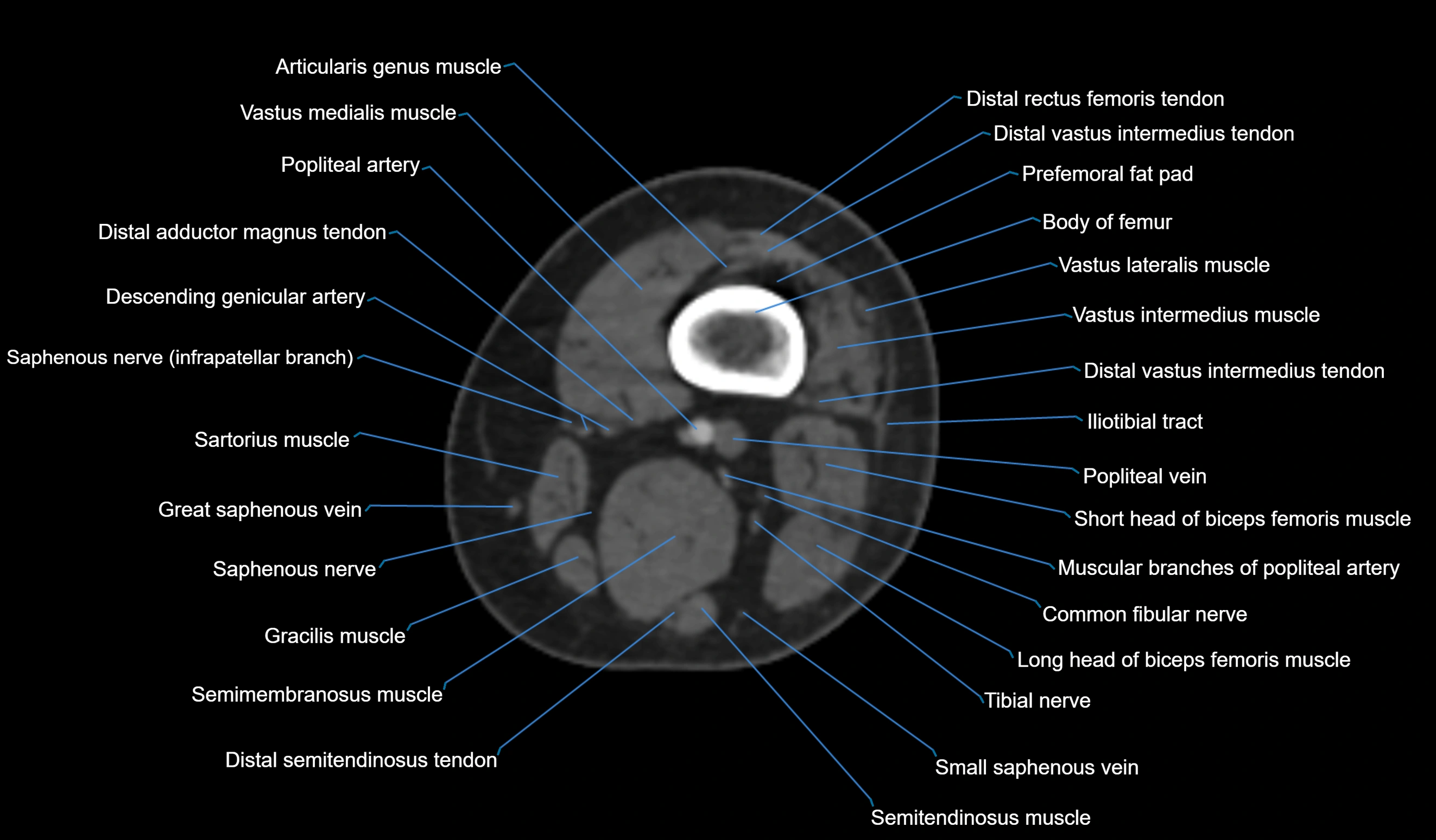 CT knee axial cross sectional anatomy labelled image-00006.webp